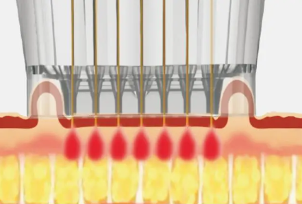 黃金微針射頻術後皮膚恢復護理示意