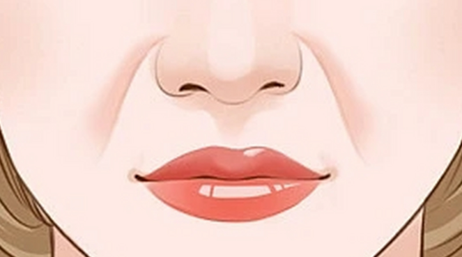 法令紋玻尿酸填充注射示意,注射層次與劑量影響效果