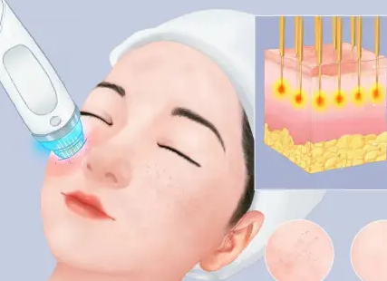 醫美術後修復面膜保濕護理,術後第一周護膚重點