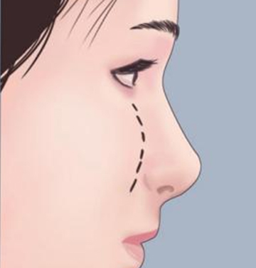 蘋果肌打薄溶脂針效果