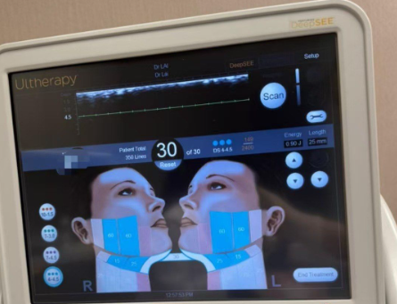 美版超聲刀Ultherapy介紹