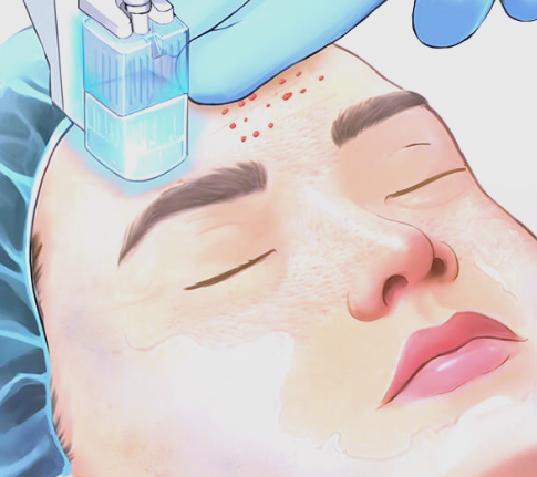 Prosedur suntik water light di klinik kulit Korea