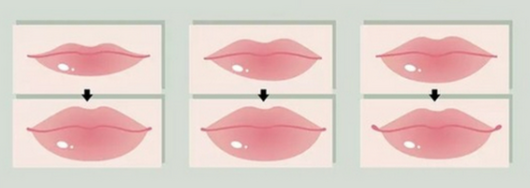 韓國豐唇手術對比