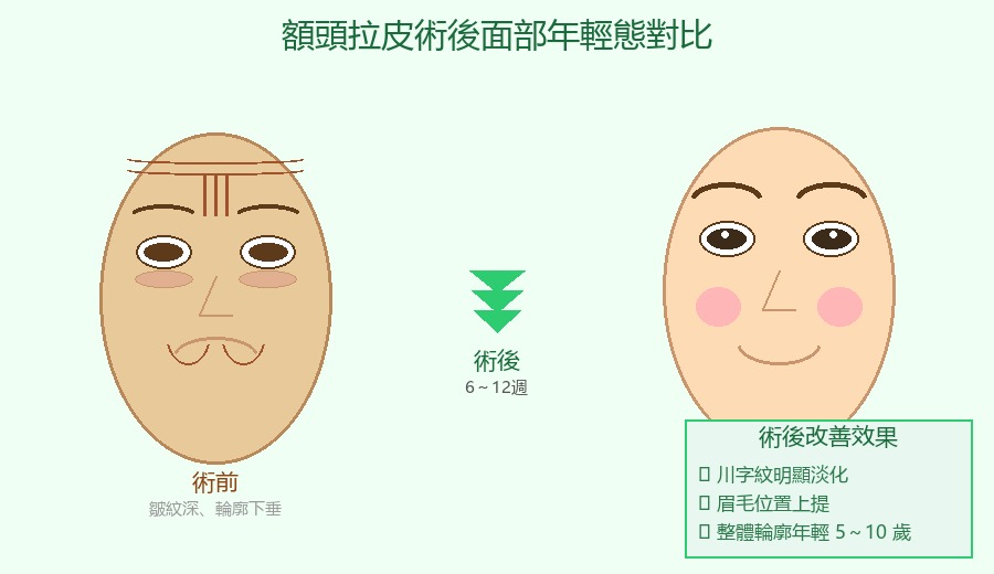 額頭拉皮術後面部年輕態對比|川字紋改善輪廓提升效果