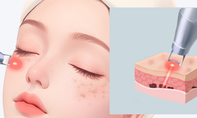 Laser Treatments Offered by Dermatology Clinics on Jeju Island