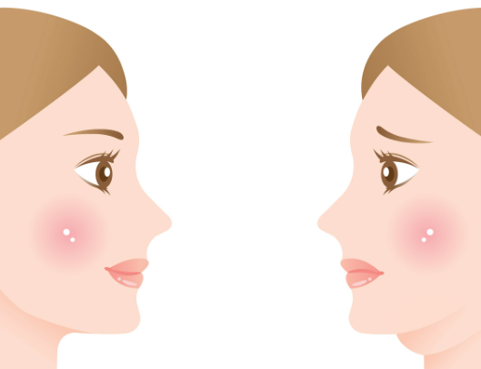 Schematic illustration of the fat-dissolving mechanism of Onda’s super-microwave Double Chin treatment