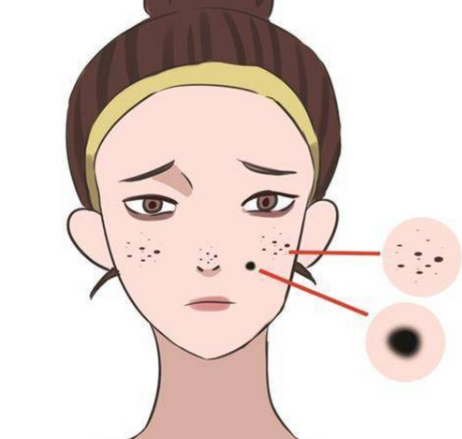 切除痣掛皮膚科還是美容科示意圖