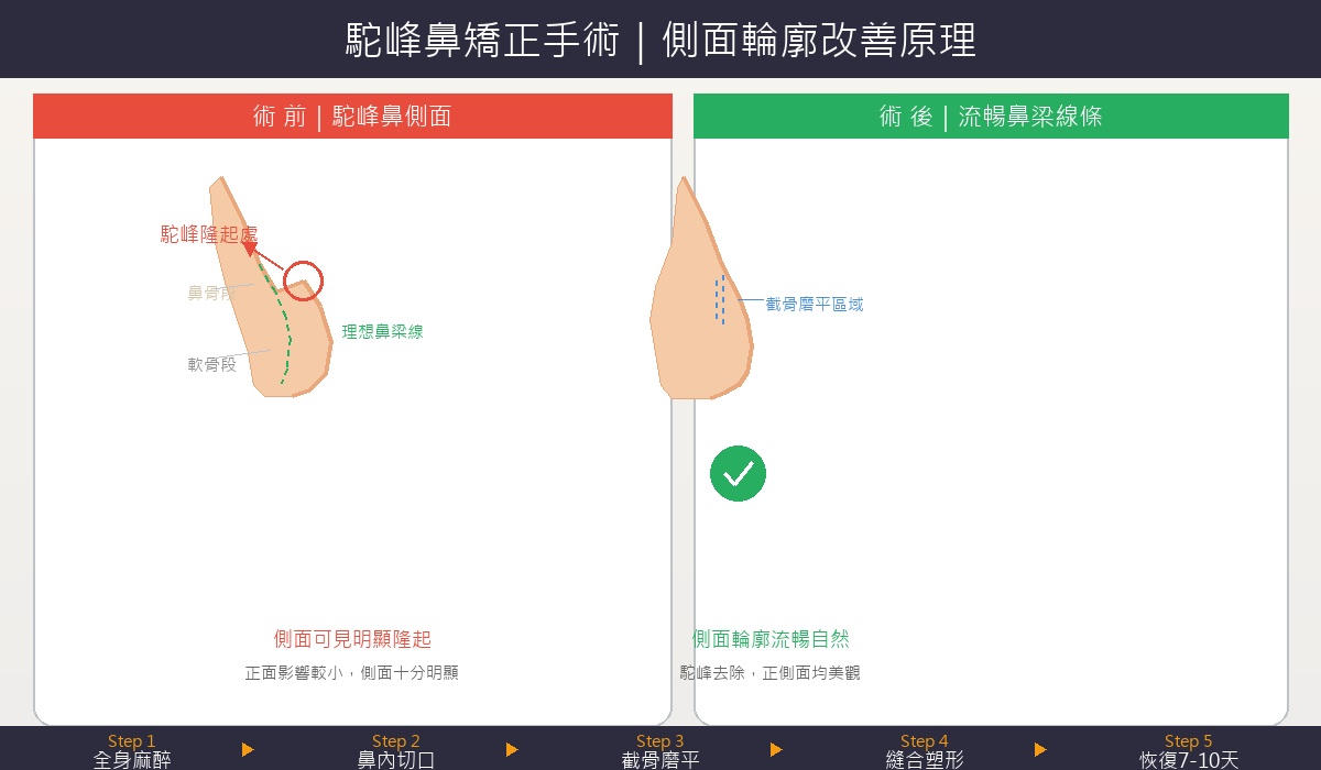 韓國駝峰鼻矯正手術前後對比示意圖