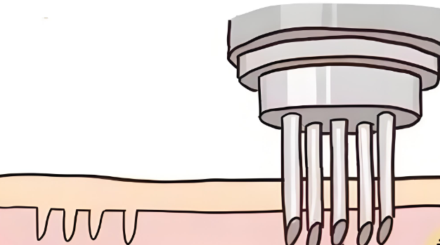 Illustration of the Effects of Hyaluronic Acid Injection