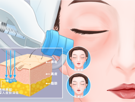 Procedures for Hyaluronic Acid Treatments in South Korea