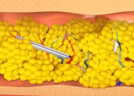 脂雕和抽脂有什麼區別?搞懂這兩種手術,才知道自己適合哪一種