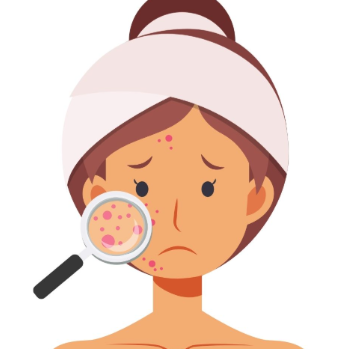 玫瑰痤瘡是什麼原因導致的?皮膚科醫師解析成因與常見誘發因素