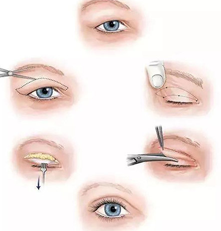 眼皮提拉術後護理完整攻略:從術後第一天到三個月的照護重點