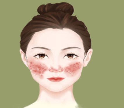 玫瑰痤瘡是什麼原因導致的?皮膚科醫師解析成因與常見誘發因素