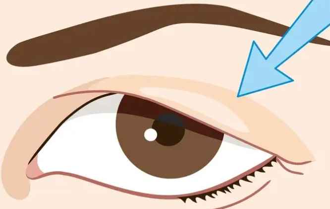 眼皮提拉術後護理完整攻略:從術後第一天到三個月的照護重點