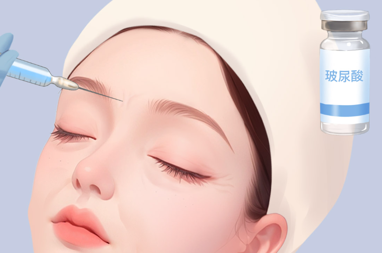 玻尿酸填充注射示意圖